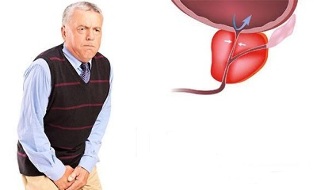 Symptome einer Prostatitis bei Männern