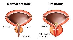 akute, prostatitis behandlung
